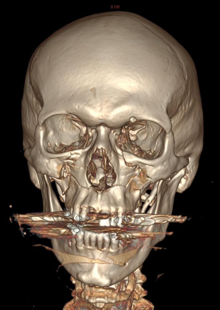 Obrázek 15 3D CT (zlomenina dle Le Fort II.
