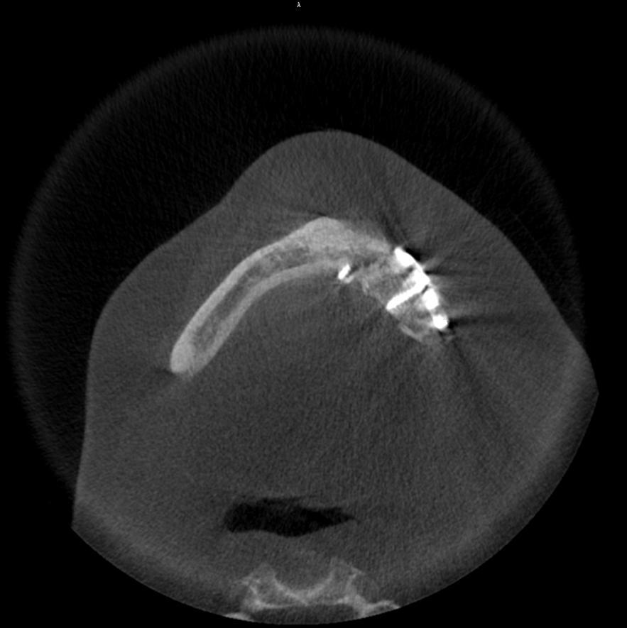 radiodiagnostiky Obrázek 23 CBCT snímek po