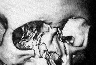 Příloha 5 Fraktura nosní kosti a očnice Zdroj: http://zdravi.euro.