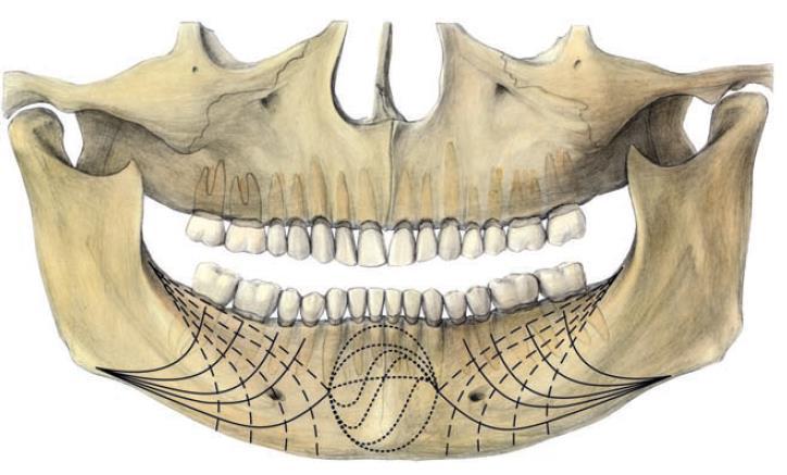 v bradovém úseku (viz obr. 6.9). V přední části dolní čelisti se zpravidla aplikují dvě horizontálně orientované dlahy, v zadní části těla mandibuly postačuje jedna, šikmo orientovaná dlaha.