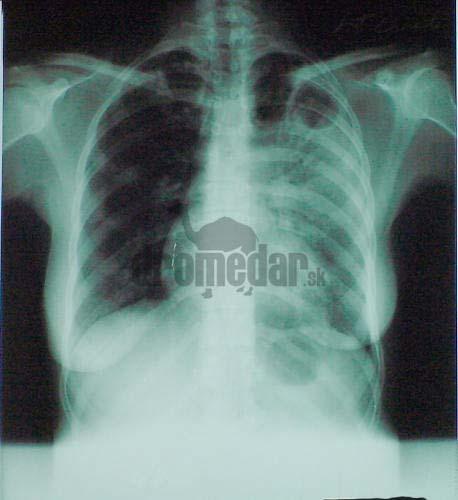 Pacienti sú obvykle hospitalizovaní 2 mesiace s uplatnením DOTS stratégie odporúčanej WHO ( Directly Observed Treatment Short Curse ) 9-mesačná dĺžka