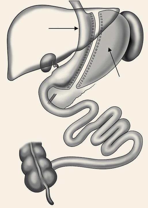 Populární gastrectomy tubulizace žaludku v Hereditárny chirurgické léčbě angioedém těžké obezity ako príčina a cukrovky bolestí 2. brucha typu tubulizovaný žaludek odstraněná část žaludku Obr. 1.