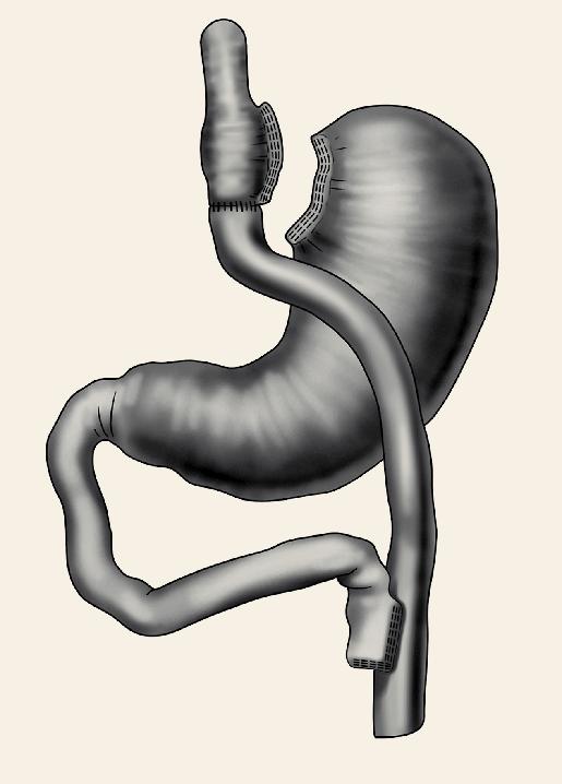 Fig. 2. Sleeve gastrectomy. obézních nemocných lze dosáhnout neoperační léčbou jen ve výjimečných případech a je velmi obtížné tento úbytek na hmotnosti udržet.