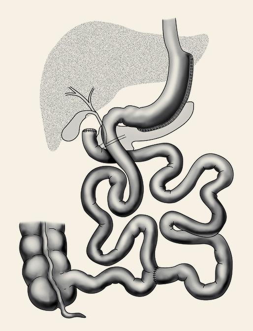 Hereditárny Populární angioedém gastrectomy ako príčina tubulizace bolestí žaludku brucha v chirurgické léčbě těžké obezity a cukrovky 2. typu Obr. 3. Duodenal switch. Fig. 3. Duodenal switch. Obr. 4.