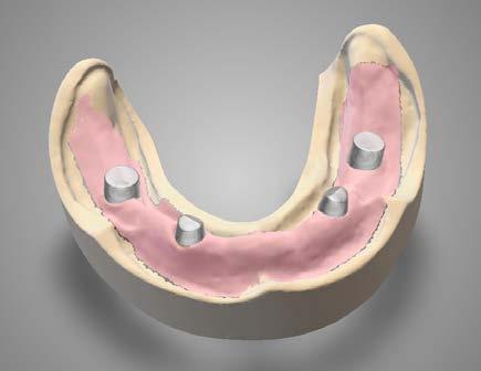 CAD Modelace Modelaci anatomického tvaru náhrady můžete změnit pomocí modelovacích nástrojů. Můžete měnit i knihovnu tvaru zubů.