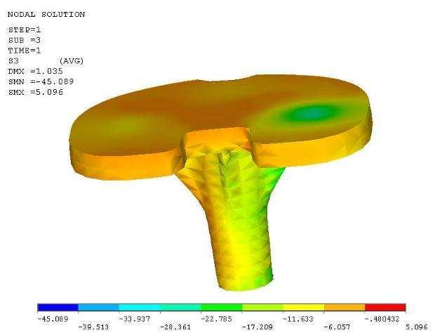 Obr. 23 Třetí hlavní napětí na kovovém dříku Obr. 24 První hlavní napětí na femorální komponentě následně konečnoprvkový model kolenního kloubu s totální endoprotézou.