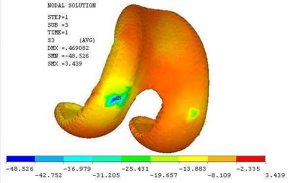 Model geometrie byl vytvořen pomocí CT řezů upravených v Rhinoceros 3.0. Úprava geometrie a následná tvorba výpočtového modelu a výpočet pomocí metody konečných prvků byl vytvořen v programu ANSYS 10.