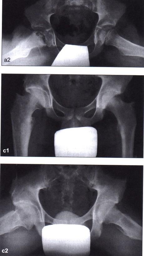 osteotomy Almost