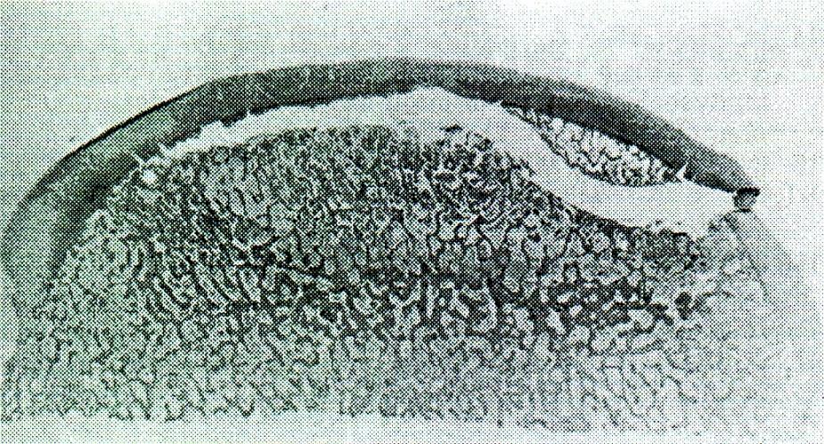 M. Calvé-Legg- Perthes Ischémie postihuje celou epifýzu Růst kloubní chrupavky pokračuje Kost je rezorbována a nahrazenou plsťovitou nezralou kostí Tato kost je měkká a vulnerabilní Vzniká