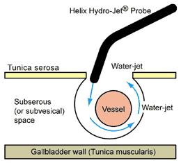 Vodní paprsek jako chirurgický nástroj Zařízení se skládá z tlakového čerpadla, vysokotlaké trubice a pracovní části produkující