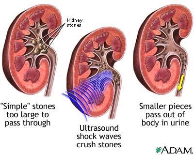 Litotripse Destrukce ledvinového kamene 50