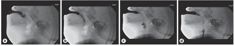 Bunová a Tedla (2009) doplňují transnazální ezofagoskopii, kterou doporučují ke screeningovému vyšetření jícnu.