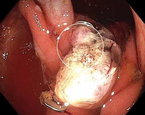 . Specimen on a cork board after an incomplete resection of LRN in the ascending colon, fragments of neoplastic tissue evident at the resection margins;. residual neoplastic tissue above the OTS clip.