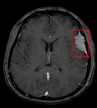U mozkových nádorů je problém ten, že rostou v uzavřeném prostoru lebky, takže i benigní nádory mohou postiženého usmrtit.