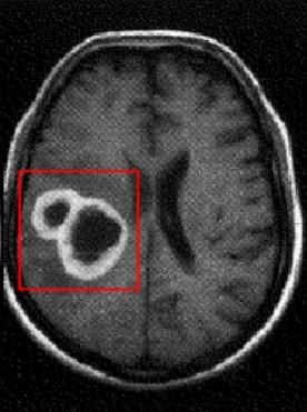 Patologie mozku 2.3 Glioblastom Glioblastom se řadí mezi zhoubné nádory, který vychází z gliových buněk. Vyskytuje se v jakémkoliv věku, častěji však v dospělosti.