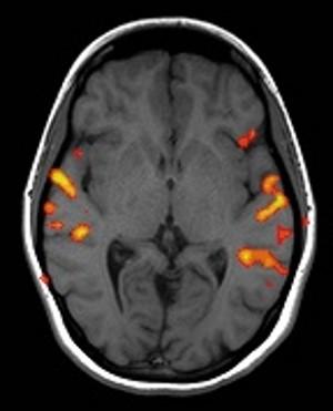 Obrázek 8: Snímek ze sonografie mozku [35] Pro detekci tumorů se také využívá funkční magnetická rezonance (fmri).