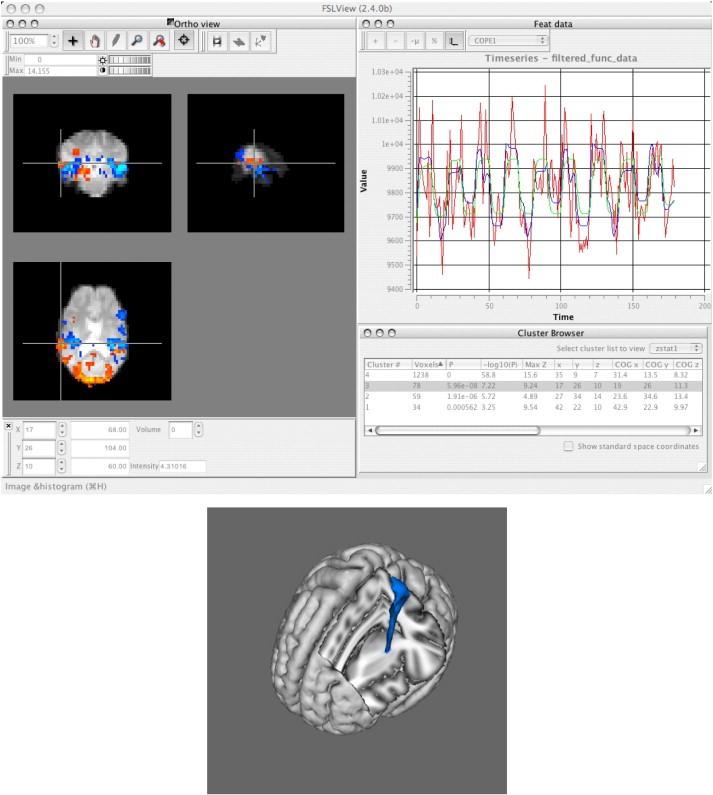 Rešerše komerčních SW pro diagnostiku mozku Obrázek 13: Horní panel: snímek obrazovky FSLView se dvěma aktivačními mapami (červené a modré) společně s výsledky seskupování.