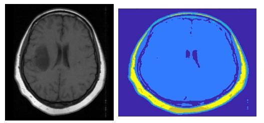 Modelování zájmových objektů z MR mozku Tabulka 1: Výsledky nalezení optimální prahovací úrovně u nativních snímků Analyzovaná skupina Glioblastom Gliomy nízkého a vysokého stupně malignity Gliomy