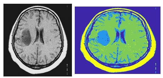 Modelování zájmových objektů z MR mozku Obrázek 31: Vlevo předzpracovaný snímek, vpravo nastavená prahová hodnota 4 Obrázek 32: Vlevo