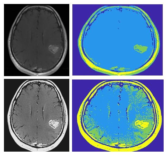 Modelování zájmových objektů z MR mozku Na Obr. 33 je znázorněn glioblastom. Prahovací úroveň u nativního snímku byla zvolena 4, stejně jako u předzpracovaného snímku.