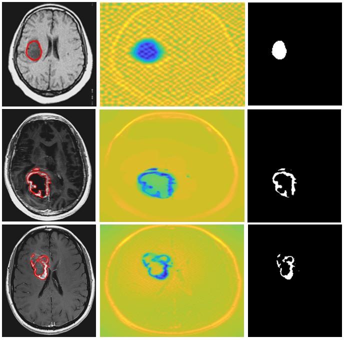 Modelování zájmových objektů z MR mozku Obrázek 39: Testování na předzpracovaných snímcích: předzpracované MR snímky (vlevo), energetická mapa aktivních kontur (uprostřed) a binární model objektů