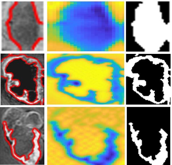 Modelování zájmových objektů z MR mozku Obrázek 40: Testování na ROI: ROI MR snímky (vlevo), energetická mapa aktivních kontur (uprostřed) a binární model objektů zájmu (vpravo) U snímku nahoře