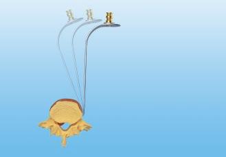 He has performed over 1,500 open anterior approaches to the lumbar spine and has also been a pioneer in anterior laparoscopic and thoracoscopic access. Now retired, Dr.