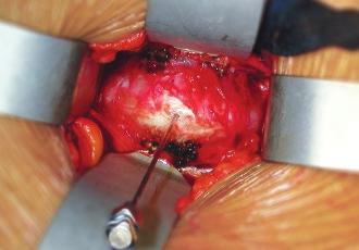In October of 2000, he presented his experience with this approach in 386 cases, along with a video of the procedure, to the North American Spine Society Annual Meeting in New Orleans.