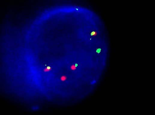 LSI IGH (14q32) Dual Color, Break