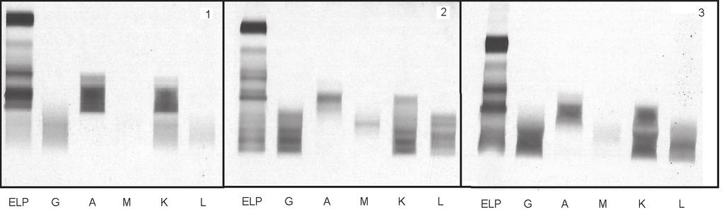 transplantation monoclonal protein IgM κ & free λ (2 gradients) 3 Eleven months after autologous transplantation - negative finding Fig. 2.