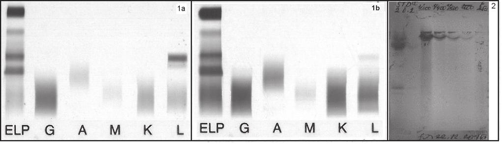 after autologous transplantation initial monoclonal protein IgA κ and oligoclonal bands 3 Nine months after autologous transplantation - original monoclonal immunoglobulin IgA κ Fig. 3. Patient with paraprotein composed of monoclonal free light chains lambda.