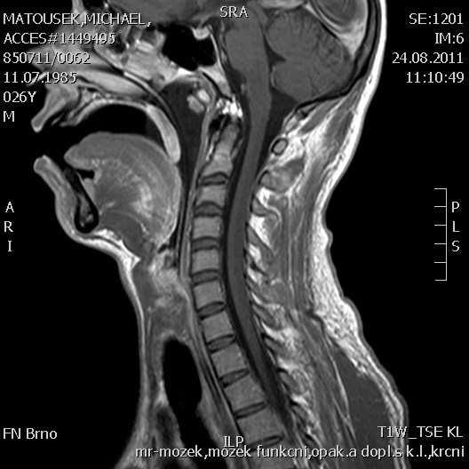 Infekční myelitis -