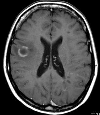 u primárně i sekundárně progresivních forem hyperintenzity v krční míše u 40 90 % SM do