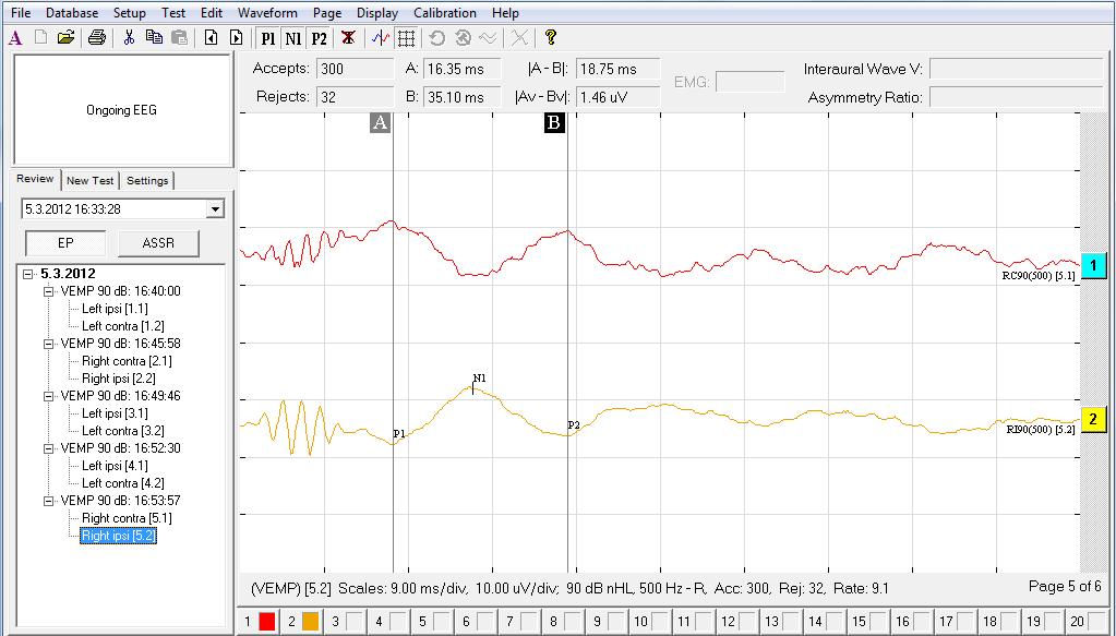 3.4.5 Měření V případě, že jsou hodnoty amplitud měřící křivky v intervalu, který byl zvolen v nastavení technických parametrů Trial settings a svítí zelená LED dioda na přístroji ISC Chartr EP 200