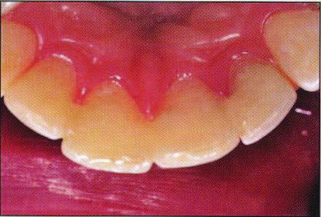 Obrázek 16: Linguální pohled na FRC vyztužující anteriorní zuby [17] Zubní můstky se aplikují do míst, kde došlo k úplné ztrátě zubu. Rozlišujeme několik typů můstků.