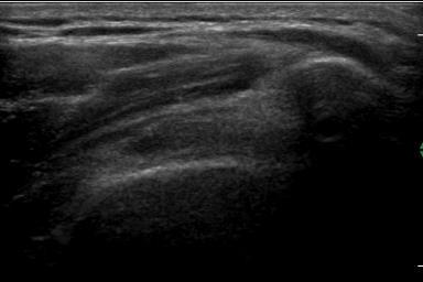 Impingement syndrom Subacromiální impingement - při