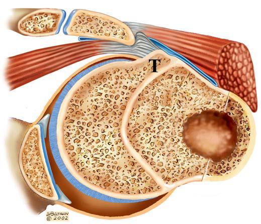 Impingement