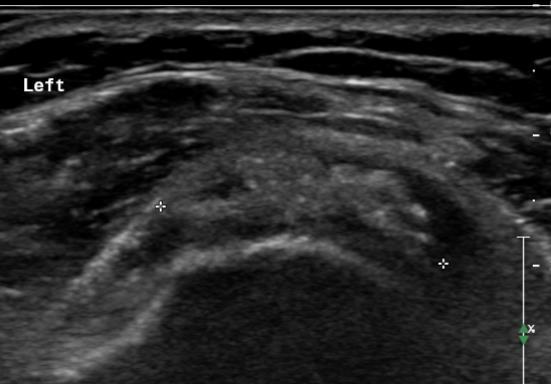 nejčastěji supraspinatus - 1-2 cm od úponu na velký hrbol Angello De