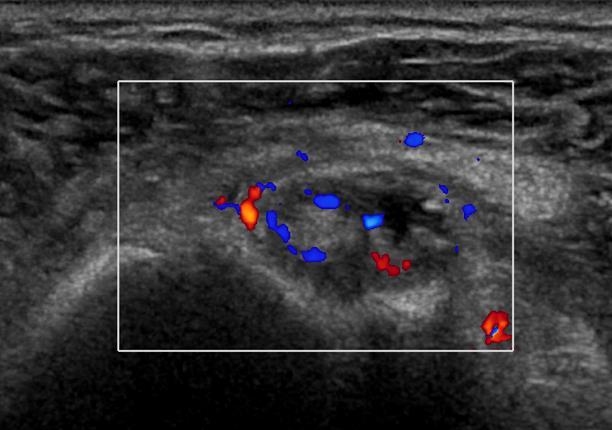 Synovitis