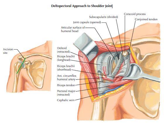 Příloha 3: Deltopektorální přístup Obrázek 4: