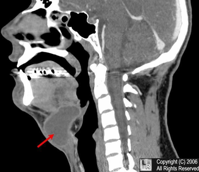 Cysty ductus thyroglossus http://www.surgical-tutor.