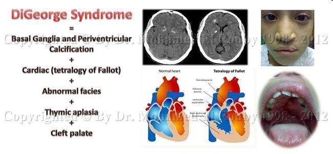 DiGeorgův syndrom
