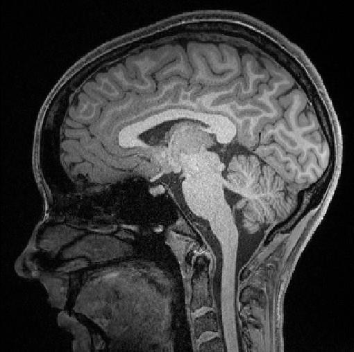 2.3.1 Funkční magnetická rezonance Funkční magnetická rezonance (fmri) je neinvazivní, moderní zobrazovací metoda, s poměrně vysokým prostorovým a přijatelným časovým rozlišením, sloužící k funkčnímu