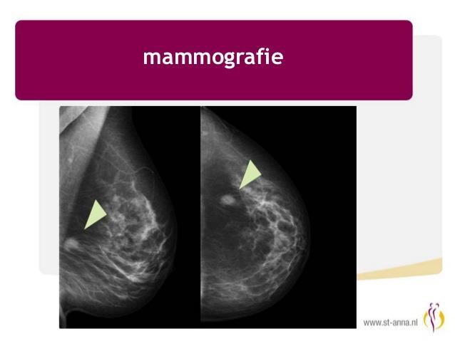 DIAGNOSTIKA Mammografie základní vyšetření