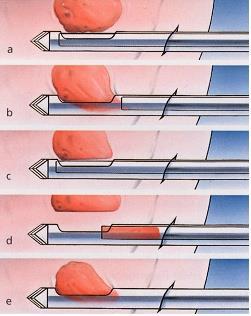 mammografii, core cut