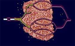 CHEMOEMBOLIZACE Ovlivnění přes arteriální zásobení nádoru - hepatocelulárního ca Kombinace regionální intraarteriální CHT + embolizace Výhody-mnohonásobně vyšší koncentrace CHT (doxorubicin,