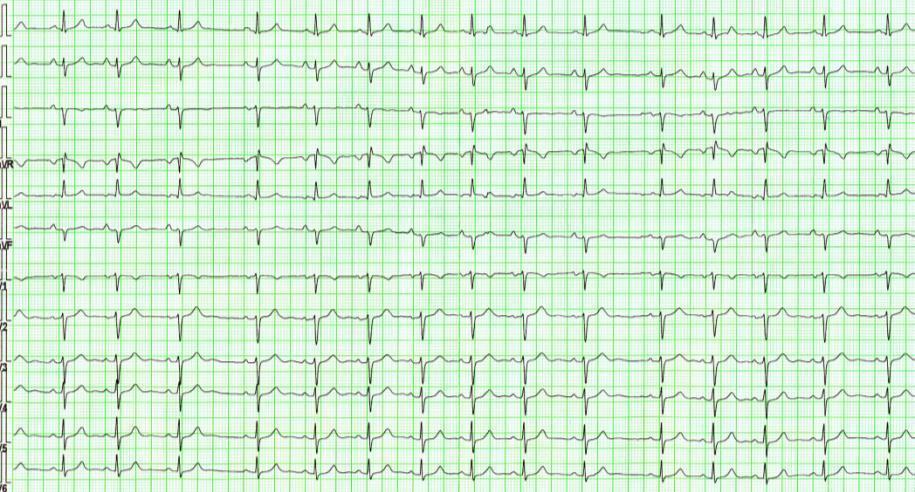 EKG 1