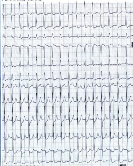 EKG 3 I II III avr