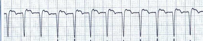 Kasuistika 3 Popis EKG: