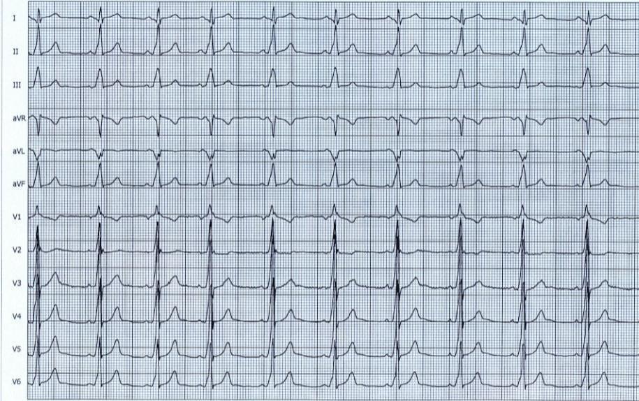 EKG 3A SR